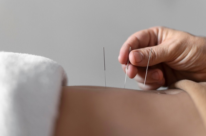 Acupuntura