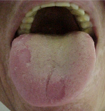 língua amarela
